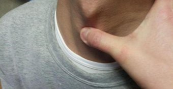 Где располагается щитовидный хрящ и что делать если болит гортань?
