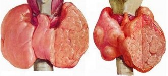 Что представляет собой  и как лечится узловой токсический зоб?