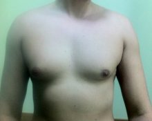 Какие существуют способы лечения гинекомастии у мужчин?