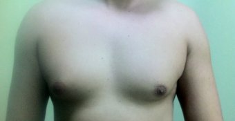 Какие существуют способы лечения гинекомастии у мужчин?